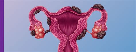 endometriose de parede cid